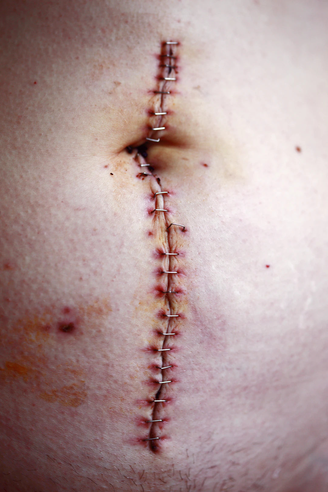 Understanding Surgical Sutures Absorbable vs Non-absorbable