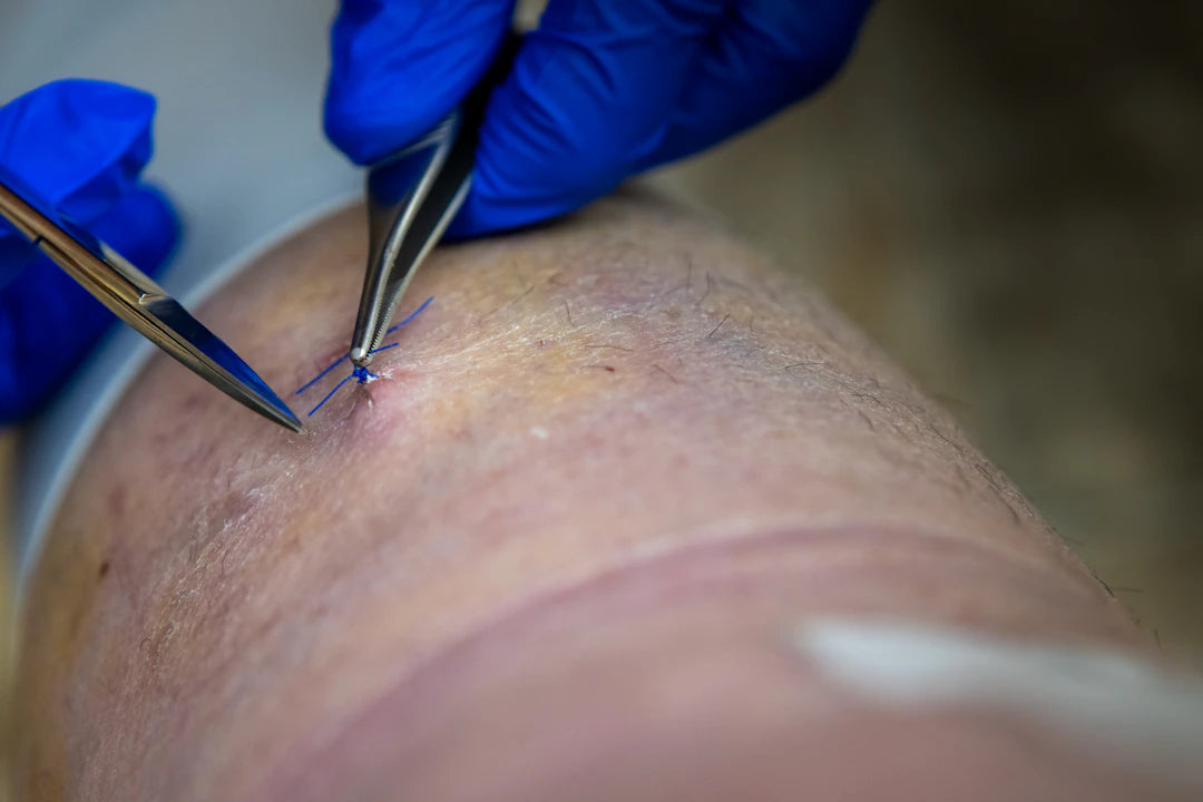 Discover the Essentials of Surgical Sutures Today
