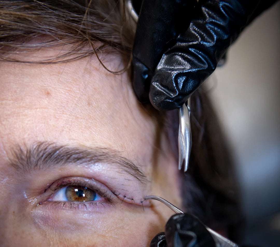Effective Absorbable Sutures for Surgical Wound Closure