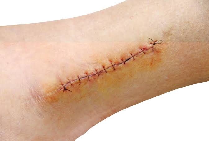 The Essential Role of Sutures in Wound Healing